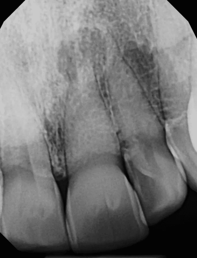 Calcified tooth root canal pre-op x-ray by Dr. Sullivan of Mason Endodontics and Microsurgery