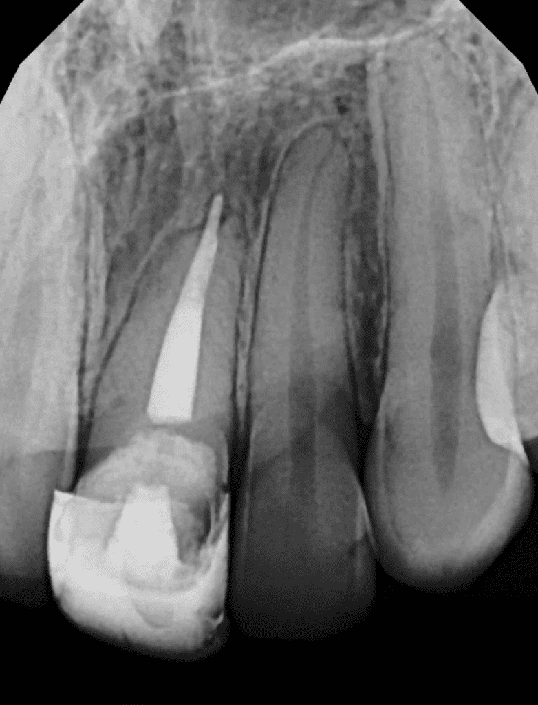 Maxillary incisor pre-op radiograph prior to root canal retreatment by Dr. Matthew Sullivan of Mason Endodontics and Microsurgery.