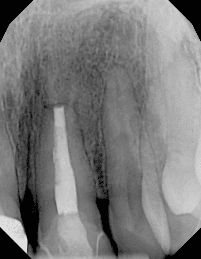 6-month recall showing excellent healing after endodontic surgery by Cincinnati endodontist Dr. Sullivan of Mason Endodontics and Microsurgery