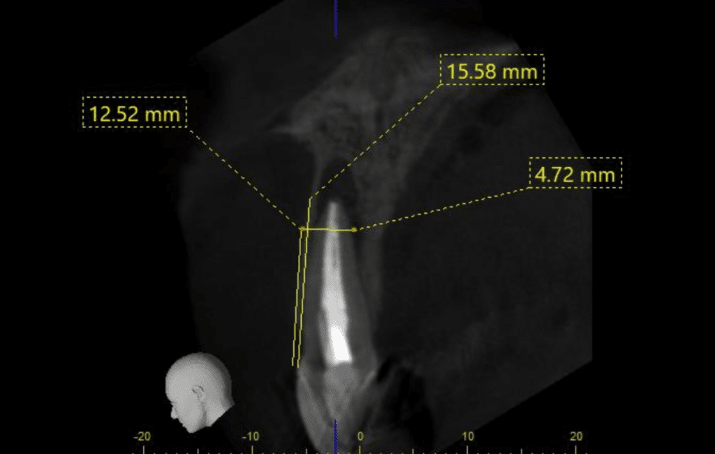 CBCT treatment planning prior to apical surgery by Cincinnati endodontist Dr. Sullivan of Mason Endodontics and Microsurgery