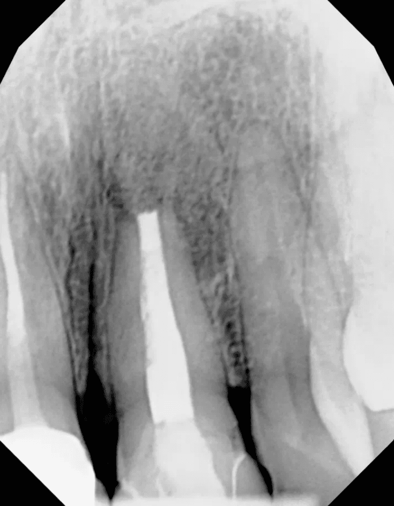 Endodontic microsurgery completed by Cincinnati endodontist Dr. Matthew Sullivan of Mason Endodontics and Microsurgery