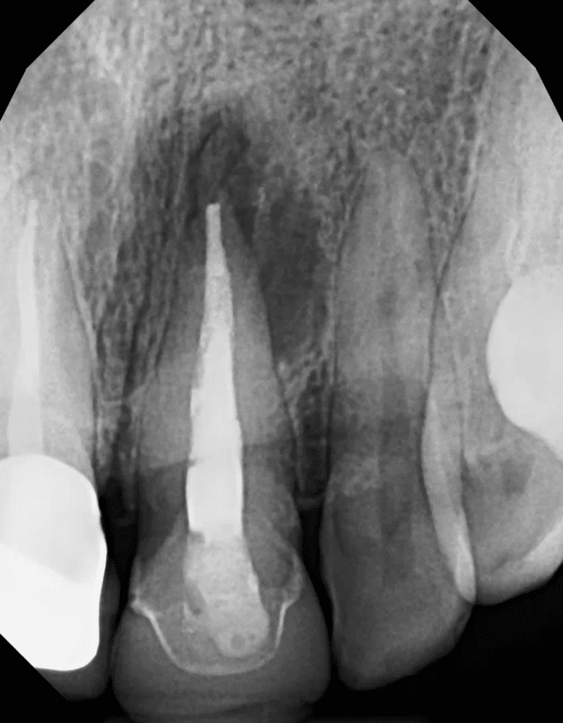 Maxillary incisor pre-op radiograph prior to endodontic surgery by Dr. Matthew Sullivan of Mason Endodontics and Microsurgery.