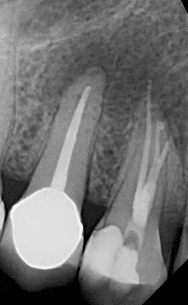 Pre-molar root canal post-op by Cincinnati endodontist Dr. Sullivan of Mason Endodontics and Microsurgery.