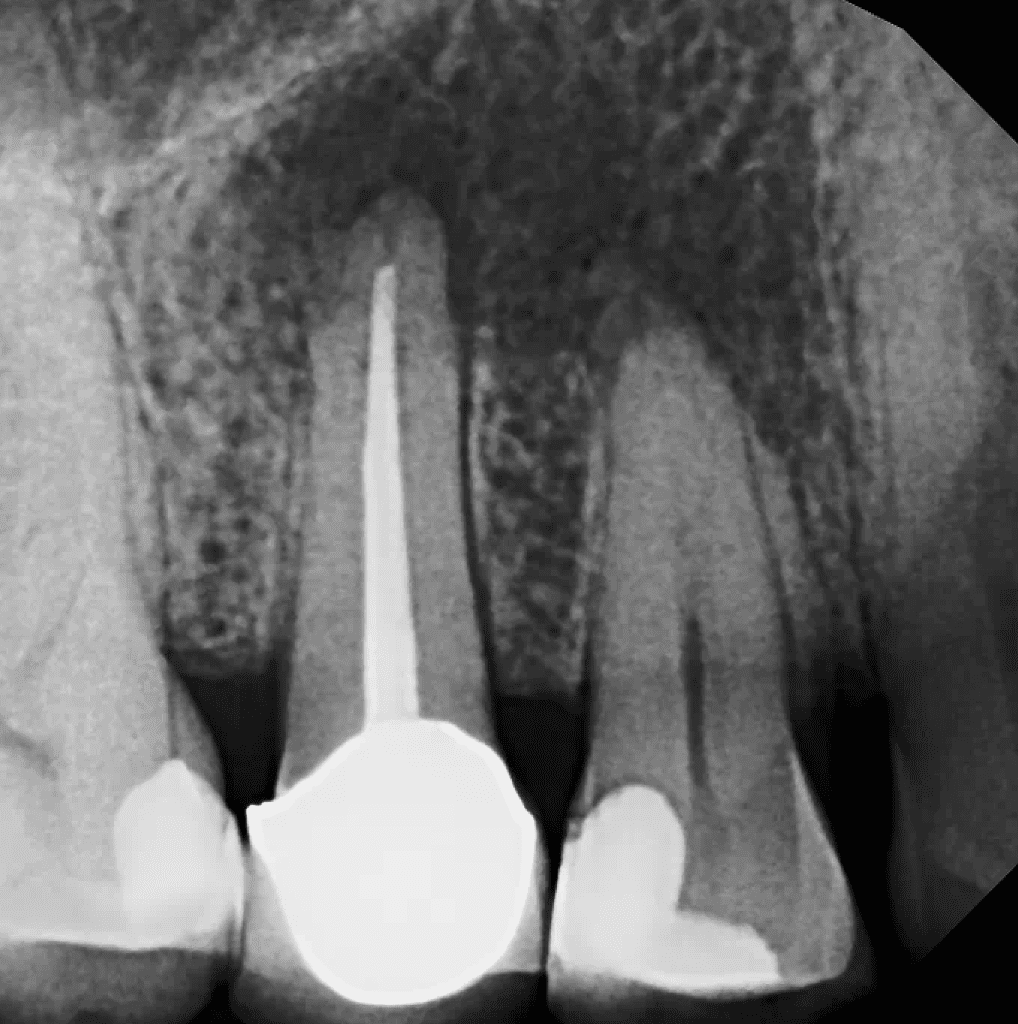 Pre-molar root canal pre-op by Cincinnati endodontist Dr. Sullivan of Mason Endodontics and Microsurgery.