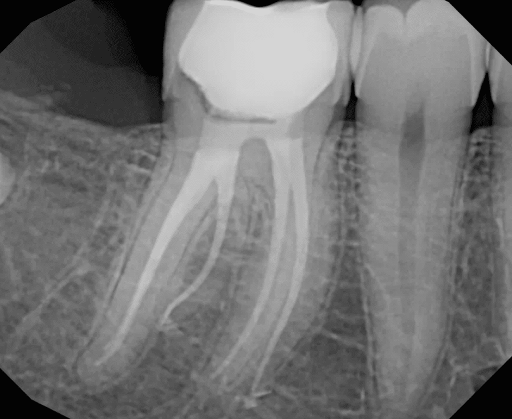 Lower molar with radix root canal post-op completed by Dr. Matthew Sullivan