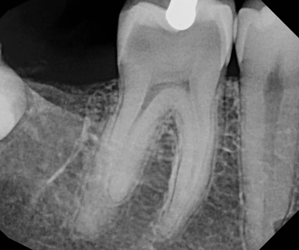 Lower molar with radix root canal pre-op completed by Dr. Matthew Sullivan