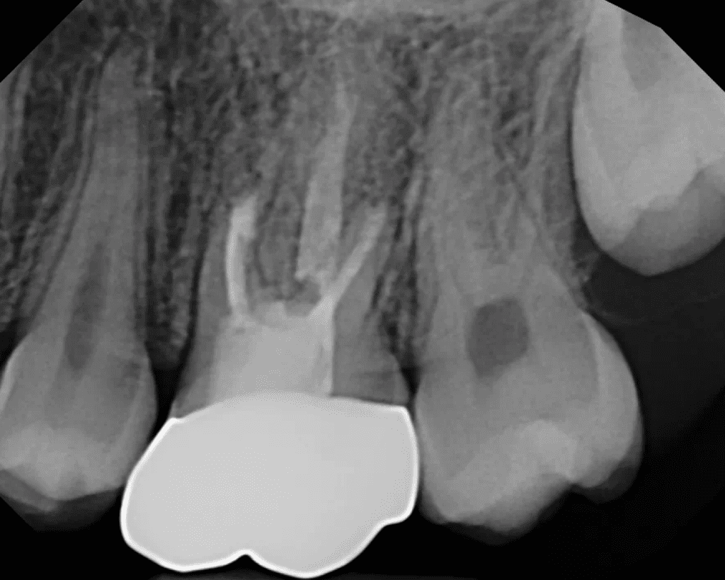 Endodontic surgery 6-month recall xray by Dr. Matthew Sullivan of Mason Endodontics and Microsurgery - excellent radiographic healing 