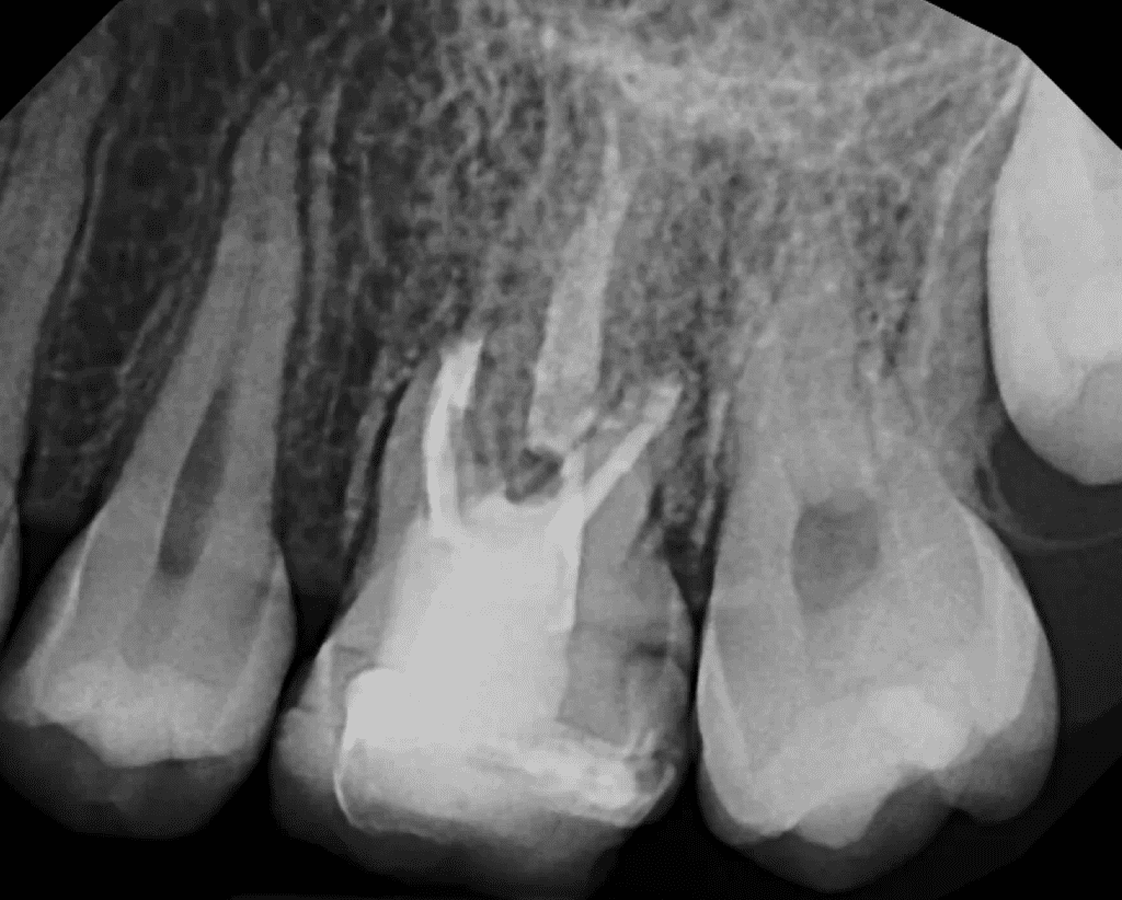 Endodontic surgery post-op xray by Dr. Matthew Sullivan of Mason Endodontics and Microsurgery
