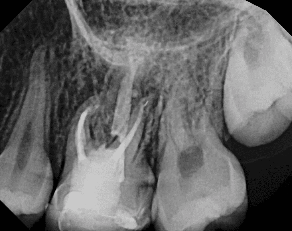 Endodontic surgery pre-op xray by Dr. Matthew Sullivan of Mason Endodontics and Microsurgery
