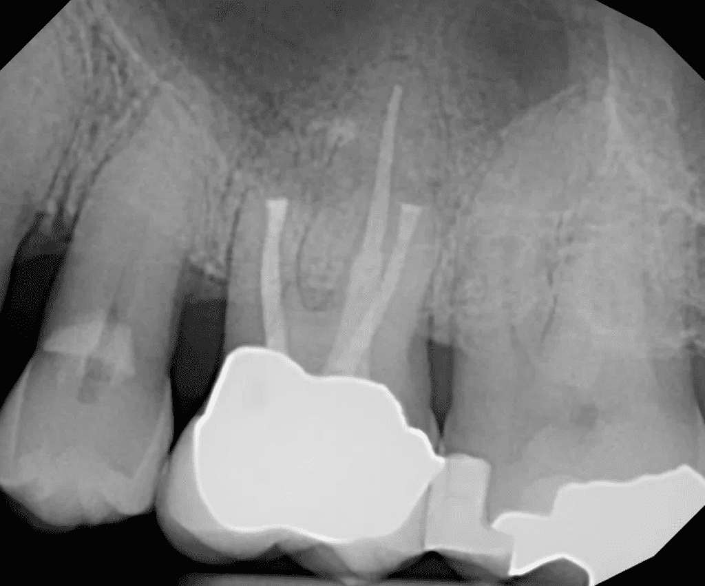 Endodontic surgery post-op xray by Dr. Matthew Sullivan of Mason Endodontics and Microsurgery