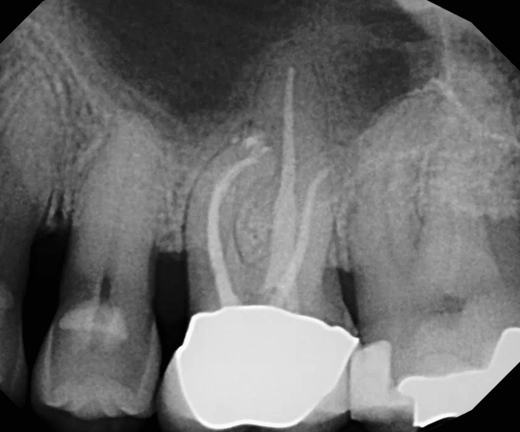 Endodontic surgery pre-op xray by Dr. Matthew Sullivan of Mason Endodontics and Microsurgery