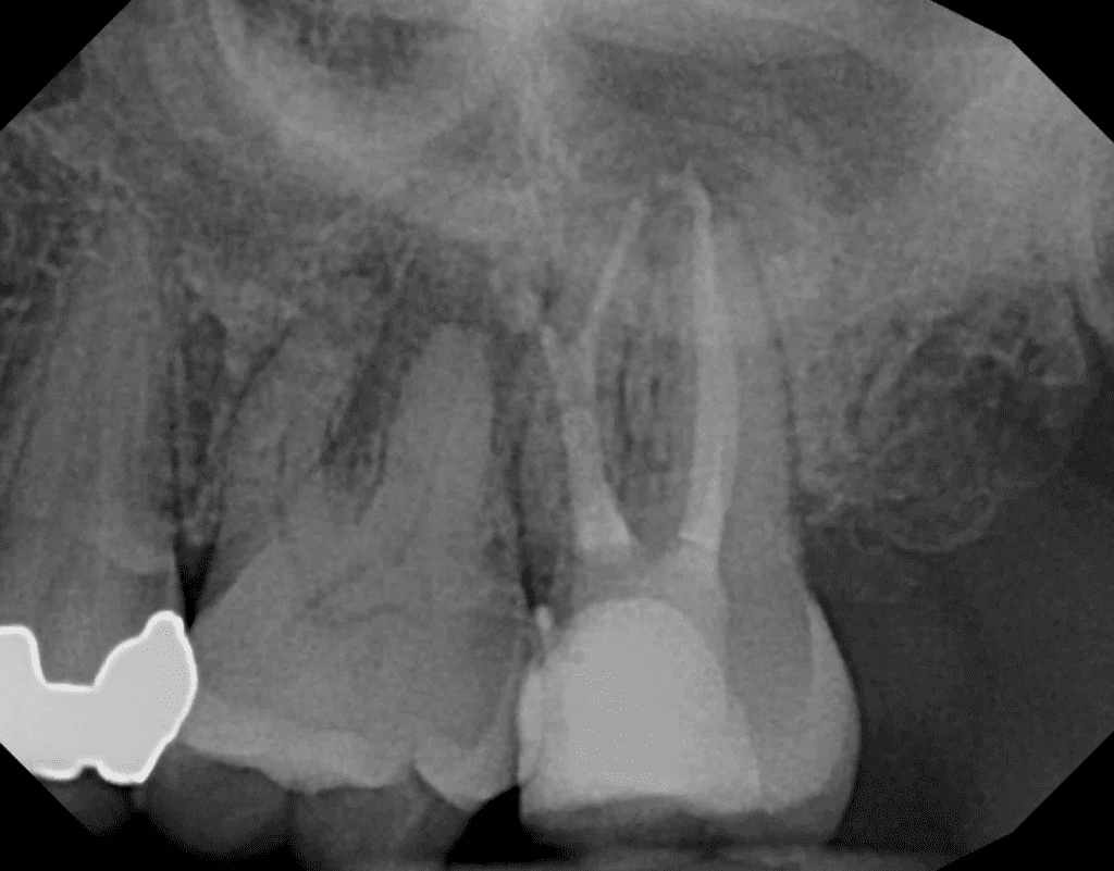 Root canal post-op x-ray showing deep lateral canal split by Dr. Matthew Sullivan of Mason Endodontics and Microsurgery