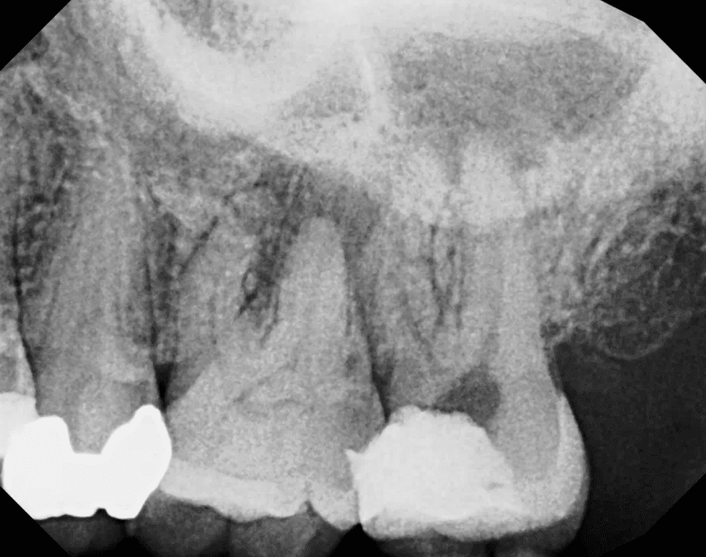 Root canal pre-op x-ray showing deep lateral canal split by Dr. Matthew Sullivan of Mason Endodontics and Microsurgery