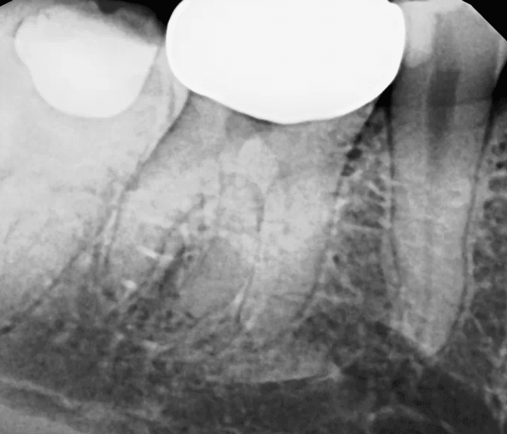 Root canal pre-op x-ray with radix by Dr. Matthew Sullivan of Mason Endodontics and Microsurgery