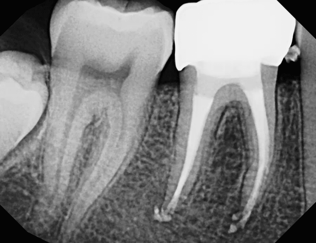 Root canal retreatment 6-month recall x-ray by Cincinnati endodontist Dr. Matthew Sullivan of Mason Endodontics and Microsurgery