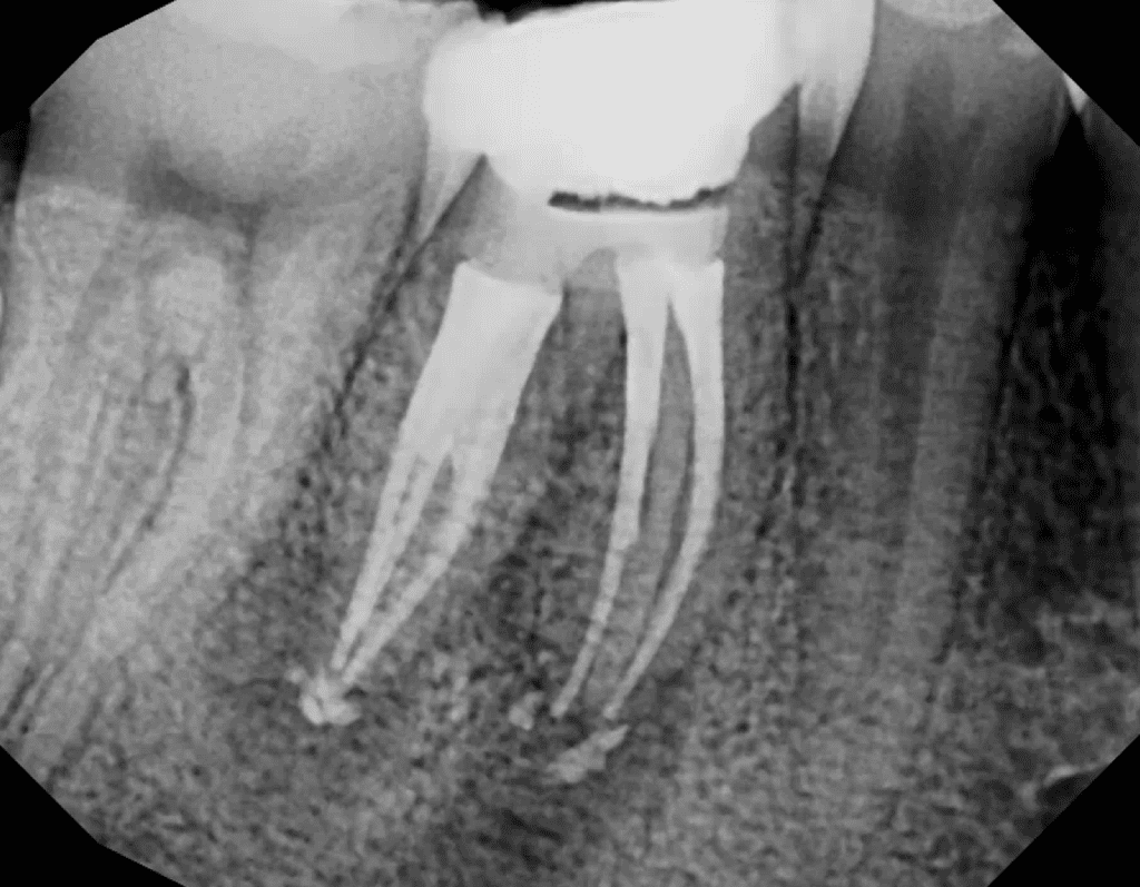 Root canal retreatment post-op x-ray by Cincinnati endodontist Dr. Matthew Sullivan of Mason Endodontics and Microsurgery