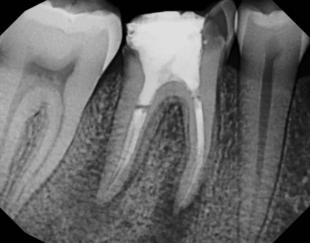 Root canal retreatment pre-op x-ray by Cincinnati endodontist Dr. Matthew Sullivan of Mason Endodontics and Microsurgery