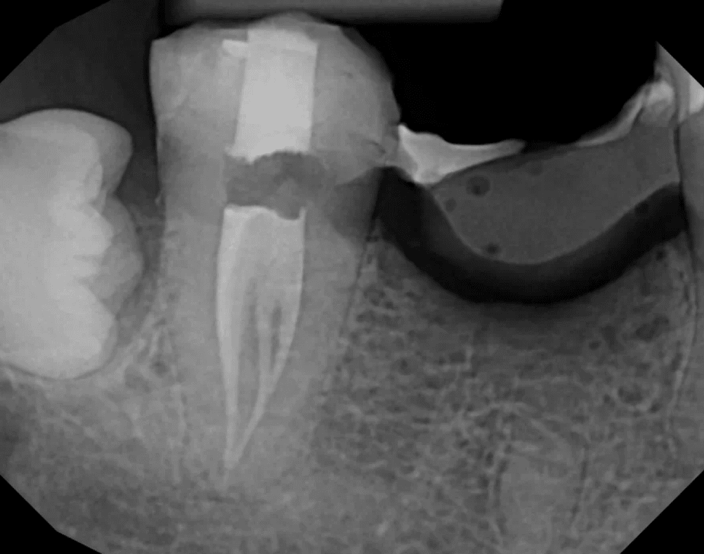 C-shaped root canal pre-op x-ray by Dr. Matthew Sullivan of Mason Endodontics and Microsurgery