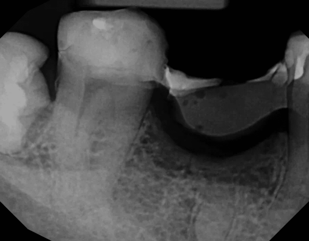 C-shaped root canal pre-op x-ray by Dr. Matthew Sullivan of Mason Endodontics and Microsurgery