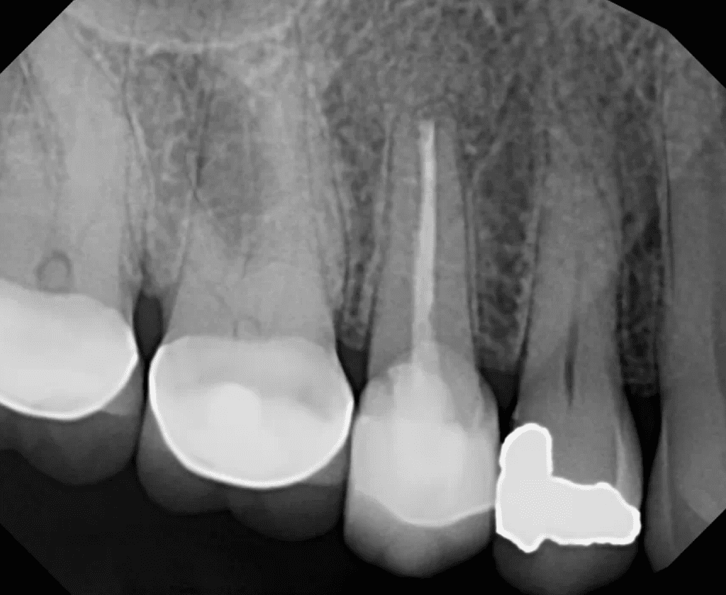 Endodontic surgery 6-month recall xray showing excellent healing by Dr. Matthew Sullivan of Mason Endodontics and Microsurgery