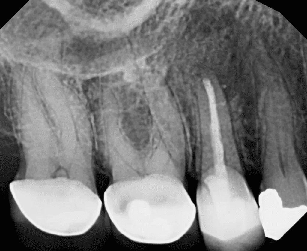 Endodontic surgery post-op xray by Dr. Matthew Sullivan of Mason Endodontics and Microsurgery