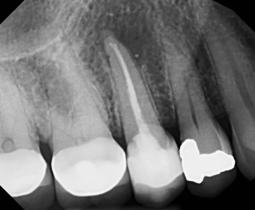 Endodontic surgery pre-op xray by Dr. Matthew Sullivan of Mason Endodontics and Microsurgery