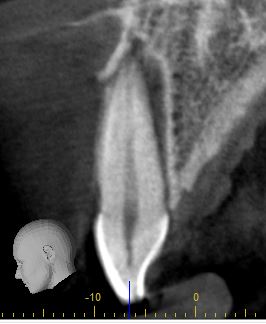 Front tooth trauma 3D CBCT Mason Endodontics and Microsurgery Cincinnati